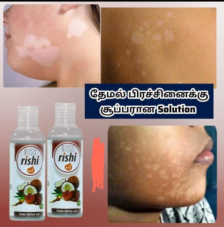 RISHI OIL AVAILABLE FOR SKIN INFECTION